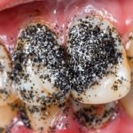 Teeth covered in small black particles.