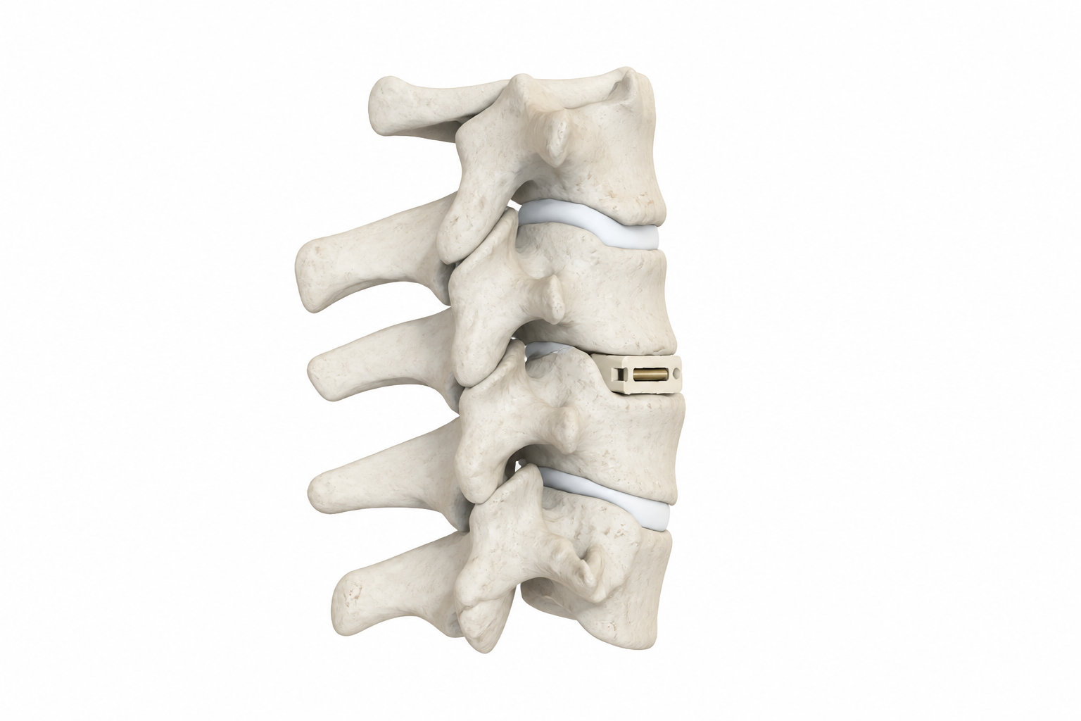 Témoignage arthrodèse cervicale : comprendre les enjeux de la fusion